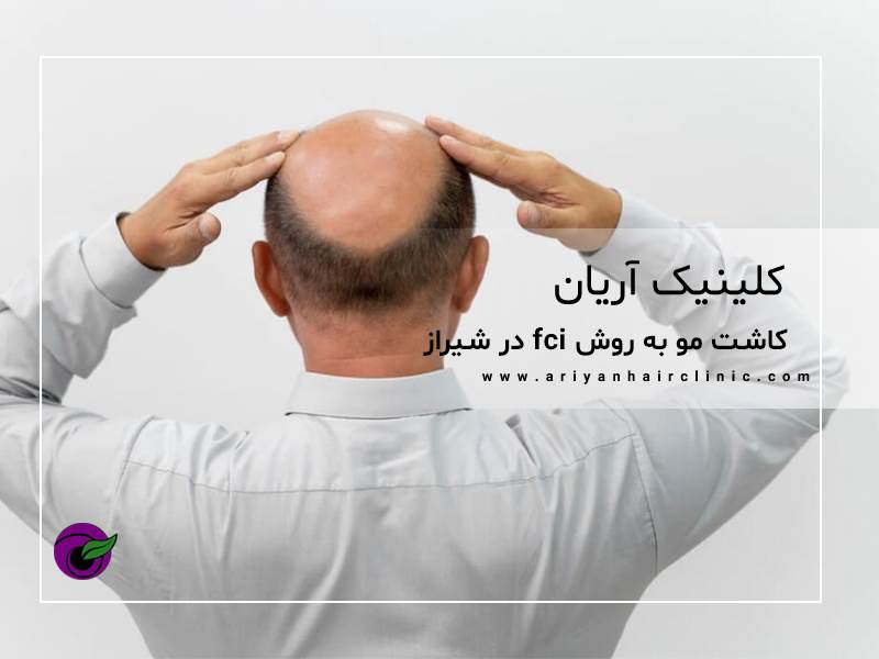 کاشت مو به روش تکثیر fci